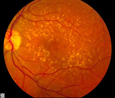 Fundus photograph showing intermediate age-related macular degeneration