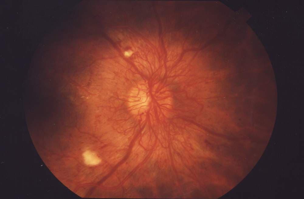 Fundus photograph showing proliferative diabetic retinopathy