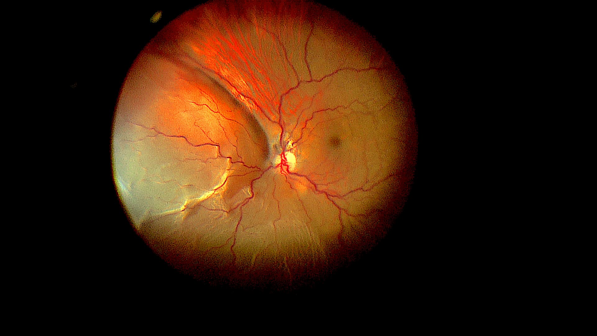 Wide-field retinal photograph illustrating retinal detachment